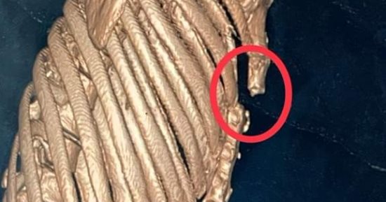 فريق جراحى ببنها الجامعى ينقذ حياة شاب أصيب بكسر فى الضلوع وفشل بالتنفس