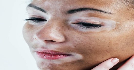 وداعا للبهاق.. "FDA" توافق على كريم موضعى جديد.. المرض يصيب الأشخاص أصحاب اضطربات المناعة الذاتية ويهاجم الخلايا الصبغية بالجلد.. العلاج الجديد يقضى على البقع خلال 24 أسبوعا بنسبة شفاء 75% للمرضى فوق 12 عاما