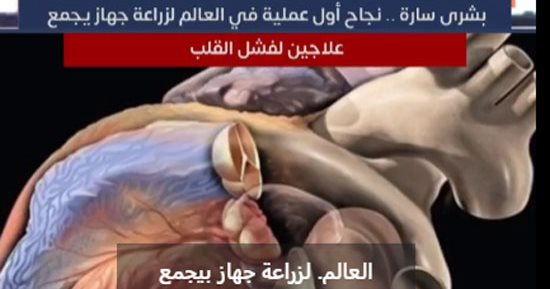 بشرى سارة.. نجاح ‫أول عملية في العالم لزرع جهاز يجمع علاجين لفشل القلب