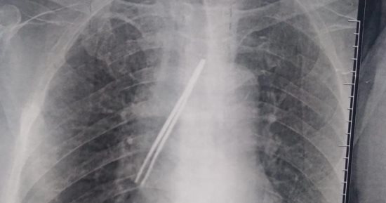استخراج "ملقاط شعر" من القصبة الهوائية لشخص ابتلعه بالخطأ.. صور