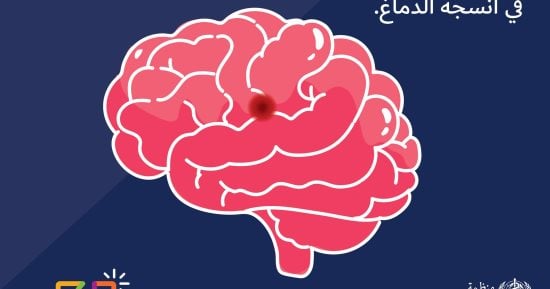 الصحة العالمية: سلوكيات خاطئة تزيد خطر الإصابة بالسكتة الدماغية