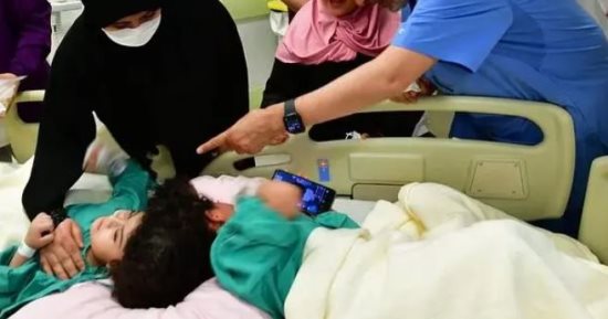 نجاح فصل التوأم السيامى المصرى سلمى وسارة بالسعودية بعد 17 ساعة فى العمليات