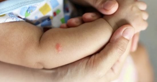 8 طرق طبيعية تساعدك لتخفيف لدغات الحشرات.. منها استخدام العسل والحليب