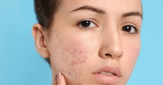 وصفات طبيعية للتخلص من ندبات حب الشباب.. من جل الصبار لزبدة الشيا