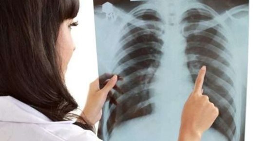 التدخين والتلوث من أكثر الأسباب شيوعًا لسرطان الرئة.. فيديو