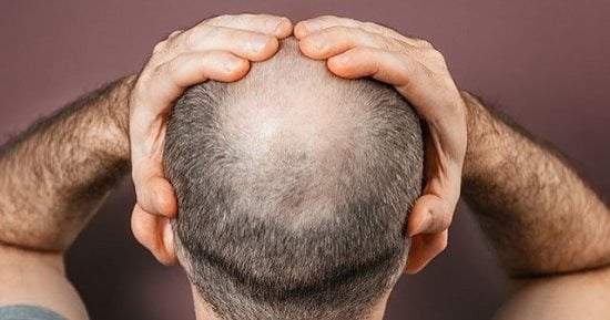 5 أكلات تسبب الصلع وتساقط الشعر للرجال