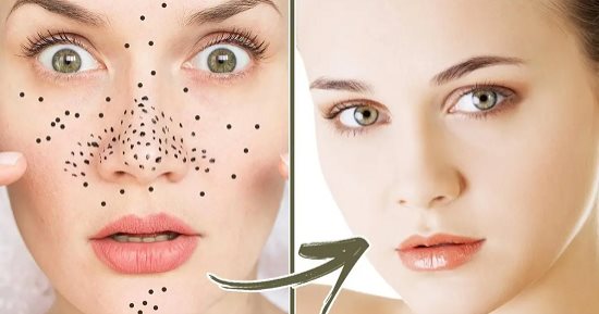 وصفات طبيعية.. 3 طرق من مطبخك تقضى على البثور وتعيد نضارتك