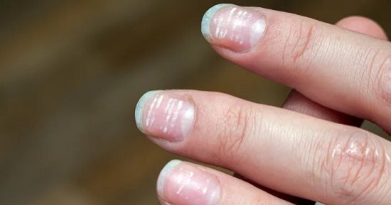 4 حيل تخلصك من الخطوط البيضاء فى الأظافر.. منها ارتداء جوانتى