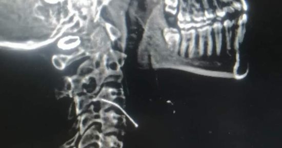 فريق طبى من كلية الطب بجامعة الوادى الجديد ينقذ حياة طفلة ابتلعت "دبوس" 