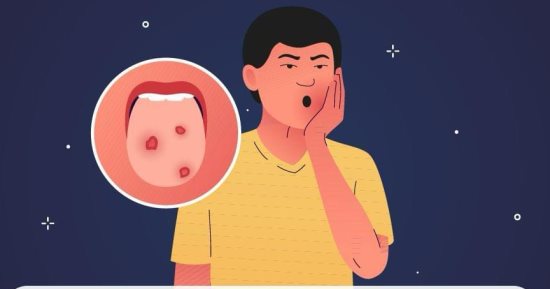هيئة الدواء تكشف 3 طرق مهمة لعلاج قرح الفم
