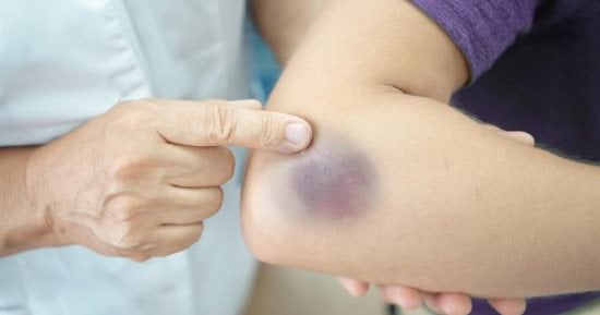 كدمة أم ورم دموي؟.. اعرف الفرق وأسباب ظهور البقع الزرقاء ومتى تحتاج للطبيب