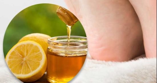 5 وصفات طبيعية تعالج تشقق القدمين.. ومن مطبخك
