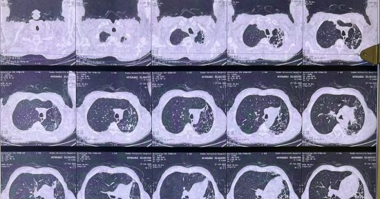 قلب مفتوح واستئصال رئة كاملة.. 3 جراحات لإنقاذ مرضي بمستشفى بنها الجامعى