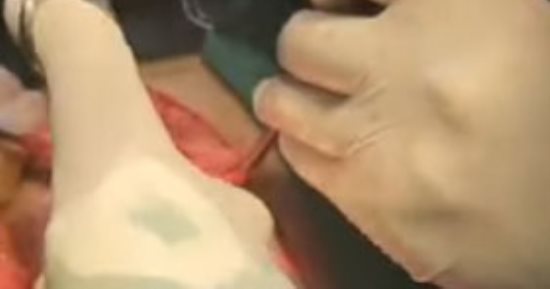 عملية جراحية لرجل يمنى بعد ابتلاعه 80 قلمًا و سماعتى أذن