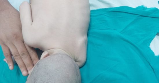 للمرة الأولى بجامعة الإسكندرية.. نجاح عملية نادرة لفصل توأم ملتصق من الرأس  