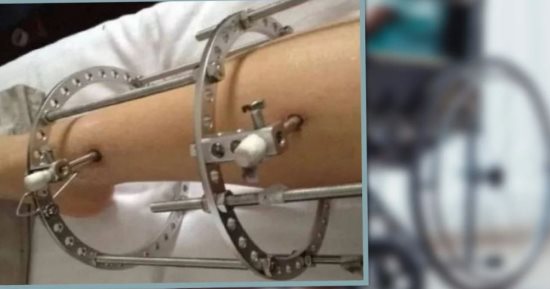 جراحة كسر العظام لزيادة الطول تتسبب في "إعاقة" صينيين