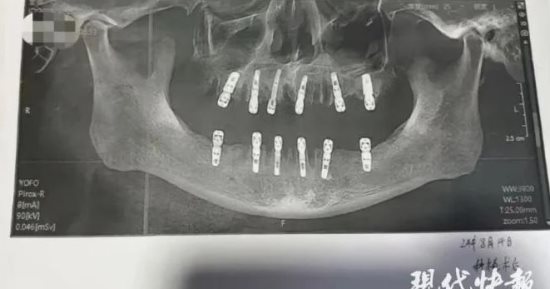 صينى يخلع 23 سناً ويزرع 12آخرين فى نفس اليوم ويموت بعد 13يوماً