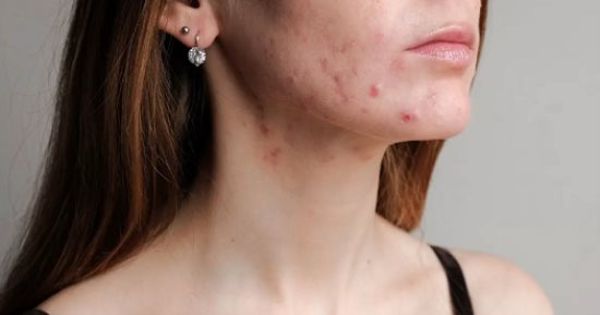 8 نصائح وخطوات للتخلص من تصبغ البشرة وندبات حب الشباب 