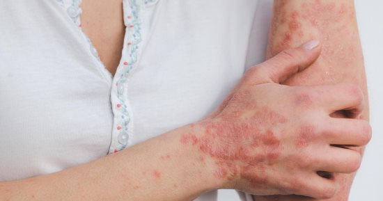 الصدفية فى الصيف.. 7 عادات بسيطة تقلل الحكة وتمنع تهيج الجلد