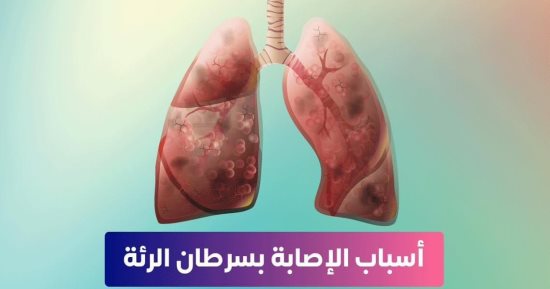 إنفوجراف.. وزارة الصحة تكشف أسباب الإصابة بسرطان الرئة