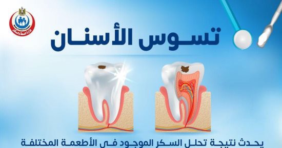 وزارة الصحة تكشف معلومات مهمة عن تسوس الأسنان .. إنفوجراف