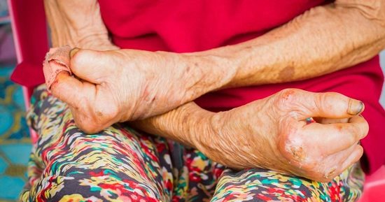 اليوم العالمى لمرض الجذام.. 5 نصائح لدعم المريض نفسياً