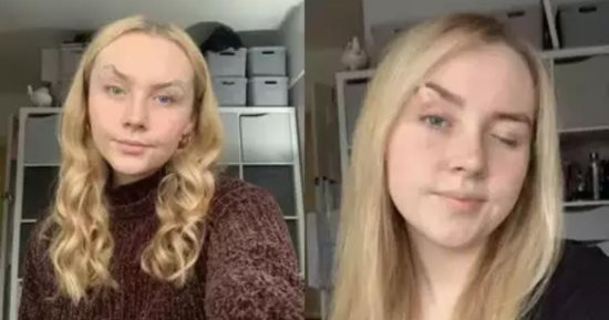 امرأة تلصق جفونها لإبقائها مفتوحة بسبب حالة نادرة للغاية.. اعرف قصتها