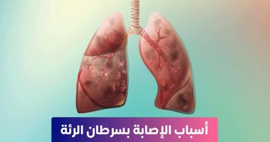 وزارة الصحة تكشف عن أسباب الإصابة بسرطان الرئة.. تفاصيل