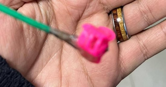 استخراج توكة شعر معدنية من معدة طفلة عمرها عام واحد بمستشفى المنصورة التخصصي