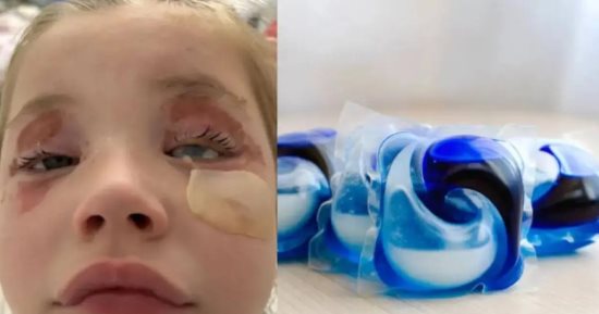 طفلة أسترالية تفقد بصرها جزئيًا بعد انفجار كبسولة مسحوق غسيل فى عينيها