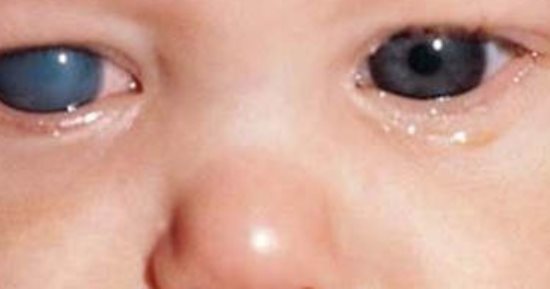 حالة نادرة الحدوث.. ما هى "الجلوكوما الخلقية" لدى الرضع وكيفية علاجها