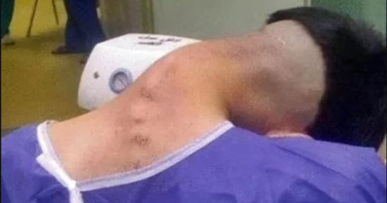 أطباء يوثقون حالة نادرة لمتلازمة الرأس المتدلي ناجمة عن تعاطى المخدرات