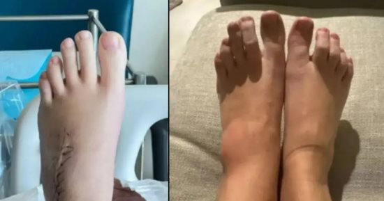 امرأة أصيبت بعدوى فطرية سببت لها فقدان ذاكرة ونوبات صرع.. كيف حدث ذلك؟