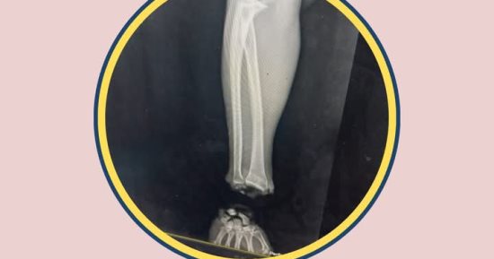 إعادة توصيل يد مبتورة بالكامل عند مفصل الرسخ الأيمن لمريض بجامعة طنطا.. صور