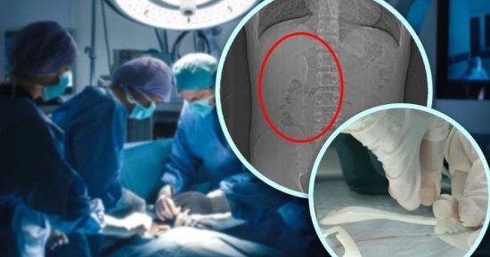 صينى ثمل يبتلع ملعقة ظنا أنه حلم ثم يكتشف الحقيقة بعد 5 أشهر