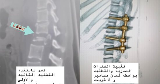 جراحات دقيقة تنقذ 3 مريضات من الشلل بمستشفى تمى الأمديد فى الدقهلية