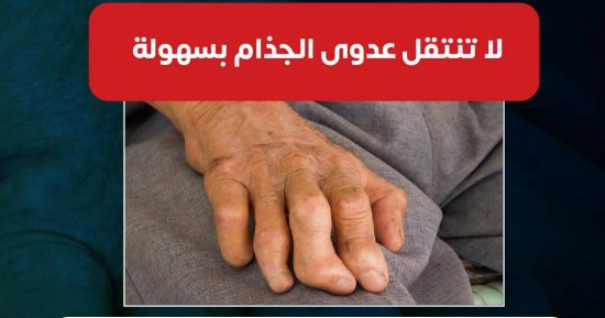 وزارة الصحة: عدوى الجذام لا تنتقل بسهولة واللمس لا يصيب بالعدوى
