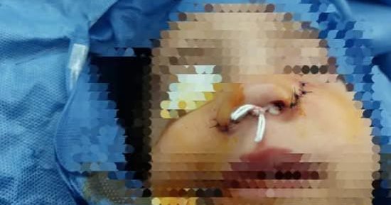 نجاح فريق جراحى بمستشفى قها التخصصى فى إنقاذ أنف طفلة تعرضت لحادث من التشوه