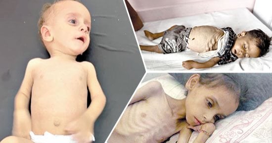 غزة بين الجوع والنار..أجساد منهكة وعظام بارزة.. شهادات من داخل القطاع توثق الكارثة.. عدى ومحمد شقيقان يفارقان الحياة بسبب المجاعة.. فادي النجار مات بعد فقد 50% من وزنه..أم تعرض ألعاب أطفالها للبيع مقابل الدقيق