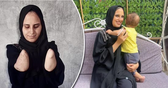 الاحتلال يقضى على أحلام "نبال الهسى".. قذيفة تستهدف خيمتها وتتسبب فى بتر يديها وتحرمها من احتضان ابنتها الرضيعة.. زوجها ينفصل عنها ويتركها مشردة مع والديها المسنين.. والأطباء يعجزون عن توفير أطراف صناعية لها