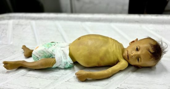 وفاة طفل فلسطينى بسبب المجاعة وتضخم فى الكبد