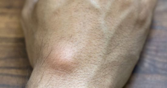 تظهر حول المفاصل.. أطباء يحذرون من محاولة تفريغ أكياس العقد العصبية