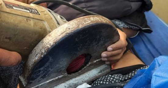 فريق طبى ينجح فى استخراج منشار كهربى استقر فى بطن طفل بدمياط
