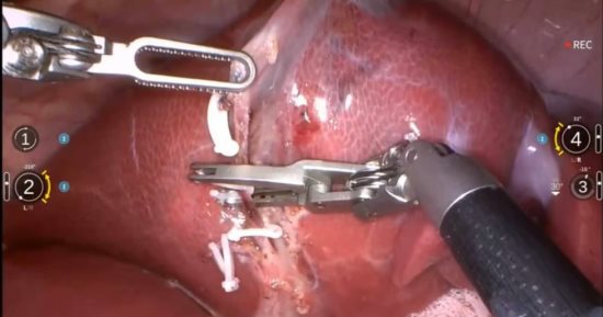 روبوت صينى يجرى جراحة معقدة على خنزير دون تدخل بشرى