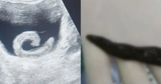 علاج شعبى مضلل يقود شابا صينيا إلى الطوارئ بعد إدخال علقة حية فى المثانة