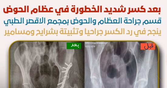 أطباء مجمع الأقصر الطبي ينجحون فى رد مفتوح لكسر خطير بعظام الحوض لمواطن