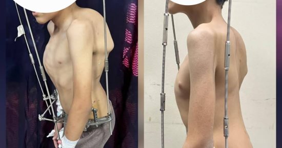 فريق طبى بمستشفى الزهراء الجامعى يجرى جراحة لتصحيح تشوه بالعمود الفقرى