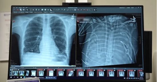 بإستخدام رئة اصطناعية.. أطباء ينجحون فى إنقاذ حياة مريض بعد استئصال رئتيه