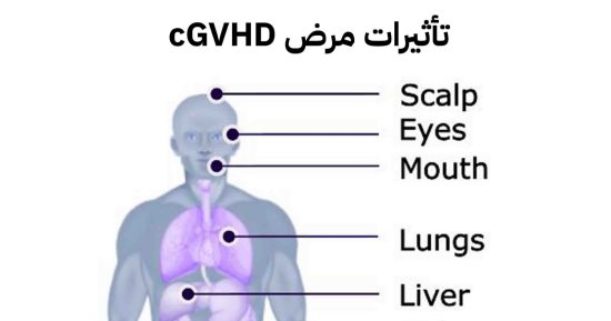 ما بعد زراعة النخاع العظمي؟