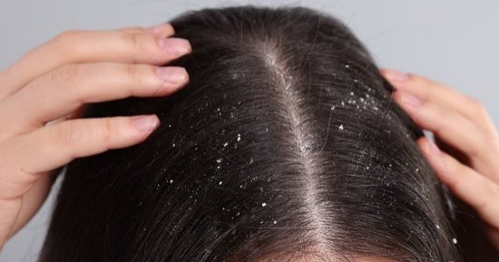 وصفات طبيعية لعلاج قشرة الرأس.. اتخلصى من الحكة والإحراج
